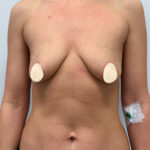 Подтяжка с увеличением - до