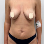 Увеличение с подтяжкой - до