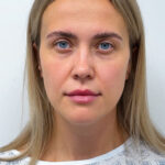 Трансконъюнктивальная + верхняя блефаропластика - до