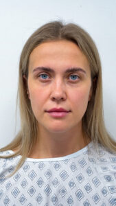 Трансконъюнктивальная + верхняя блефаропластика - до