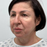 Комплексная операция на лице - до