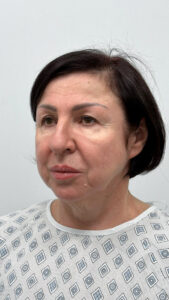 Комплексная операция на лице - до