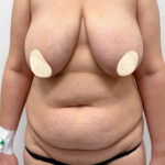 Комплексная операция - до