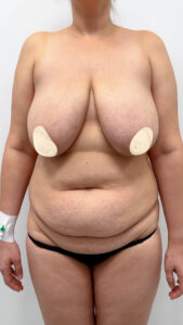 Комплексная операция - до