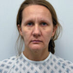 Эндоскопический лифтинг + круговая блефаропластика - до