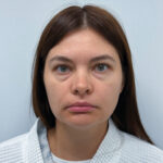 Трансконъюнктивальная блефаропластика - до