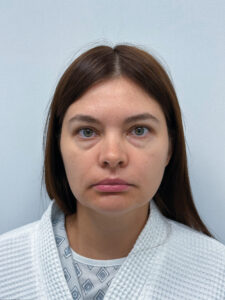 Трансконъюнктивальная блефаропластика - до