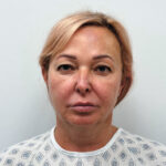 Тотальное омоложение лица - до