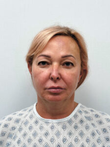 Тотальное омоложение лица - до