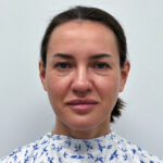 Круговая блефаропластика + эндоскопический лифтинг - до