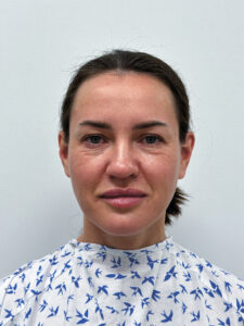 Круговая блефаропластика + эндоскопический лифтинг - до