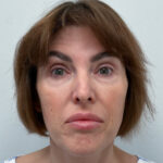 Трансконъюнктивальная блефаропластика - до