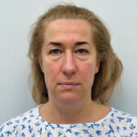 Эндоскопический лифтинг + круговая блефаропластика - до