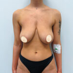 Редукционная маммопластика с подтяжкой без имплантации - до