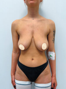 Редукционная маммопластика с подтяжкой без имплантации - до