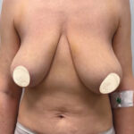 Редукционная маммопластика с подтяжкой без имплантации - до