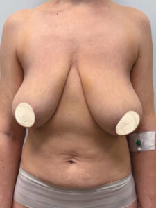 Редукционная маммопластика с подтяжкой без имплантации - до