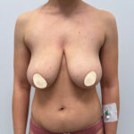 Редукционная маммопластика с подтяжкой без имплантации - до