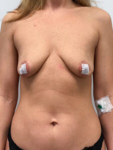 Подтяжка с увеличением - до