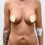 Маммопластика реэндопротезирование + абдоминопластика - до