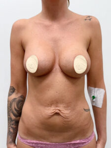 Маммопластика реэндопротезирование + абдоминопластика - до