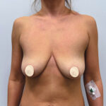 Редукционная маммопластика с подтяжкой без имплантации - до