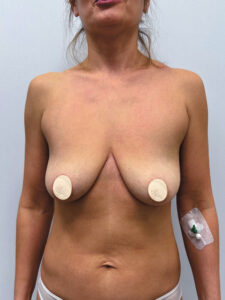 Редукционная маммопластика с подтяжкой без имплантации - до