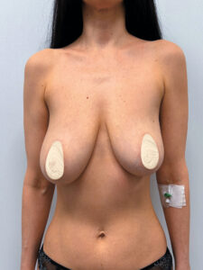 Редукционная маммопластика с подтяжкой - до