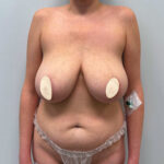 Редукционная маммопластика с подтяжкой без имплантации - до