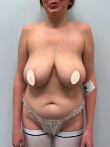 Редукционная маммопластика с подтяжкой без имплантации - до