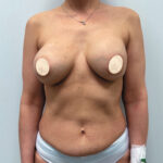 Реэндопротезирование - до