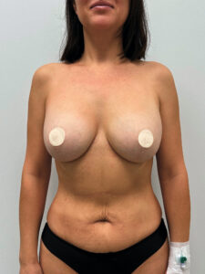 Реэндопротезирование - до