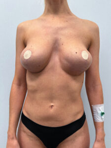 Реэндопротезирование - до