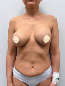 Реэндопротезирование - до