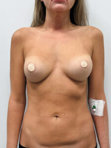 Реэндопротезирование - до