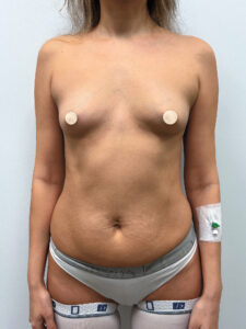 Маммопластика увеличение - до