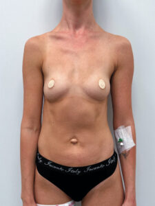 Маммопластика увеличение - до