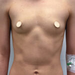 Маммопластика увеличение - до