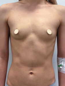 Маммопластика увеличение - до