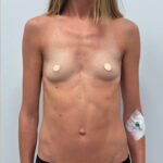 Маммопластика увеличение - до