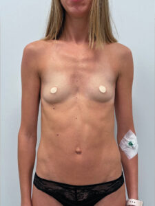 Маммопластика увеличение - до