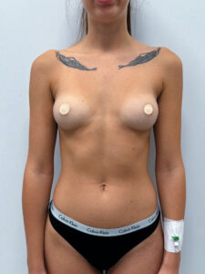 Маммопластика увеличение - до