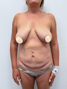 Маммопластика подтяжка + абдоминопластика - до