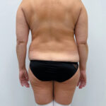 Липосакция - до