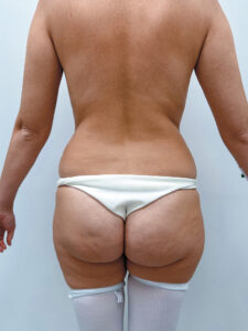 Липосакция - до