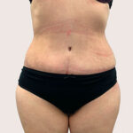 Абдоминопластика - после