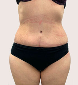 Абдоминопластика - после