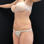 Липосакция - после