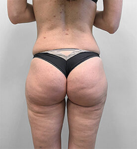 Липосакция - после