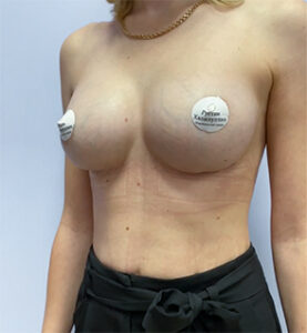 Коррекция асимметрии груди - после